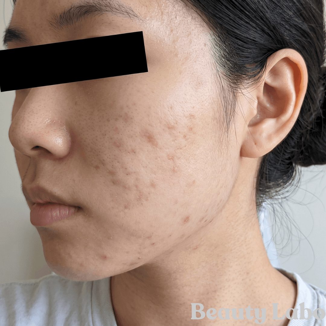 CASE03 After